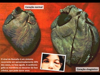 O sinal de Romaña é um sintoma
recorrente em aproximadamente 20%
dos casos, na fase aguda. A cardiome-
galia se manifesta ao decorrer da fase
crônica, que pode durar anos.
Coração normal
Coração chagástico
 