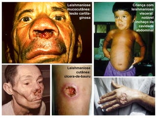 Criança com
leishmaniose
visceral:
notável
inchaço da
cavidade
abdominal
Leishmaniose
mucocutânea:
lesão cartila-
ginosa
Leishmaniose
cutânea:
úlcera-de-bauru
 