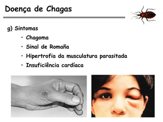 Doença de Chagas
g) Sintomas
• Chagoma
• Sinal de Romaña
• Hipertrofia da musculatura parasitada
• Insuficiência cardíaca
 