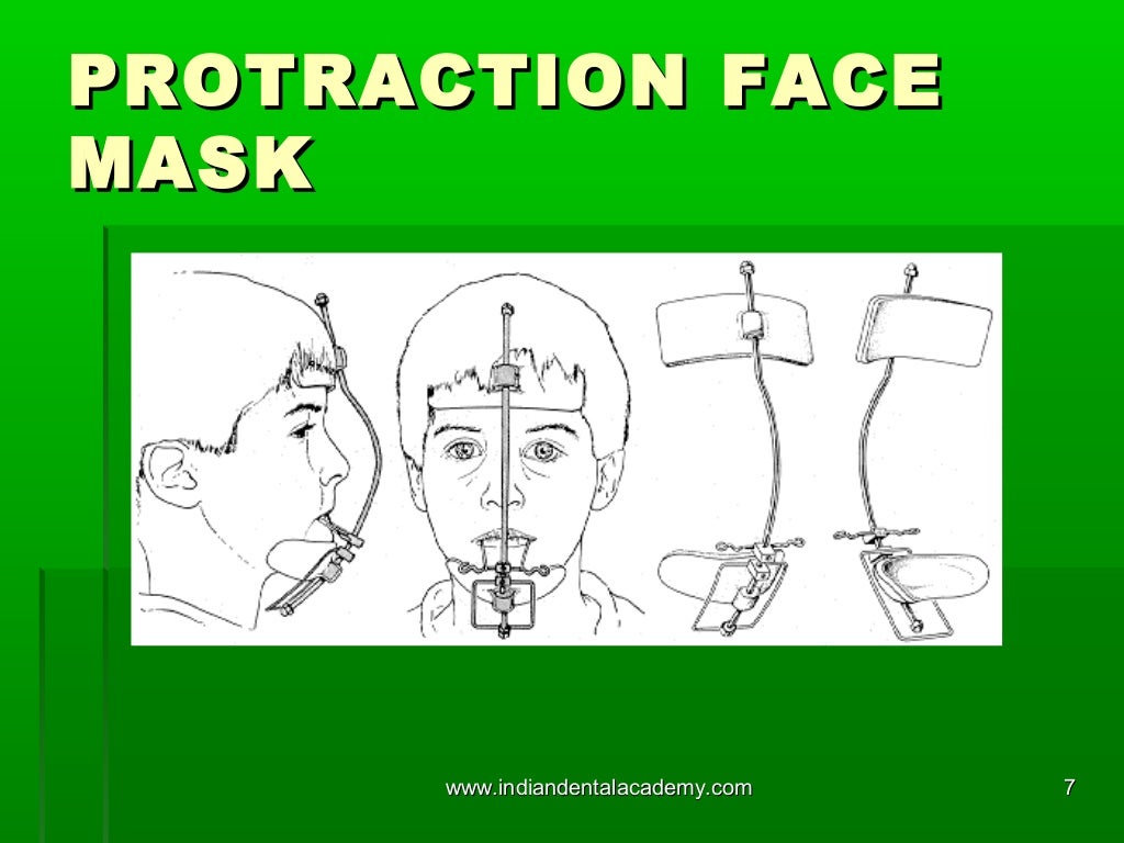 Protraction face mask /certified fixed orthodontic courses by Indian