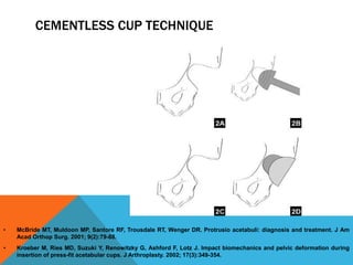 CEMENTLESS CUP TECHNIQUE
• McBride MT, Muldoon MP, Santore RF, Trousdale RT, Wenger DR. Protrusio acetabuli: diagnosis and...
