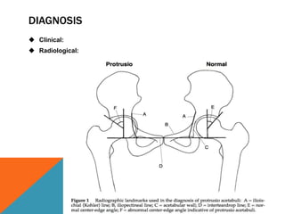 DIAGNOSIS
 Clinical:
 Radiological:
 