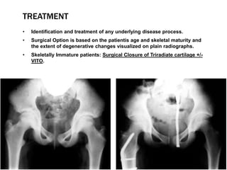 TREATMENT
• Identification and treatment of any underlying disease process.
• Surgical Option is based on the patientís a...