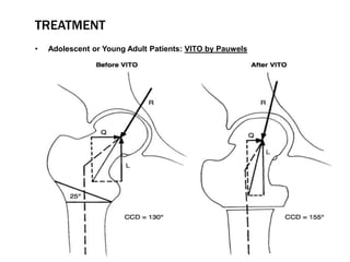 TREATMENT
• Adolescent or Young Adult Patients: VITO by Pauwels
 