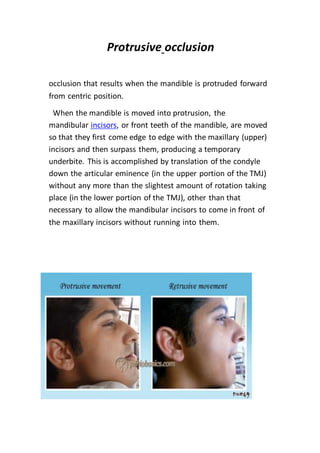 Protrusive occlusion 
occlusion that results when the mandible is protruded forward 
from centric position. 
When the mandible is moved into protrusion, the 
mandibular incisors, or front teeth of the mandible, are moved 
so that they first come edge to edge with the maxillary (upper) 
incisors and then surpass them, producing a temporary 
underbite. This is accomplished by translation of the condyle 
down the articular eminence (in the upper portion of the TMJ) 
without any more than the slightest amount of rotation taking 
place (in the lower portion of the TMJ), other than that 
necessary to allow the mandibular incisors to come in front of 
the maxillary incisors without running into them. 
 