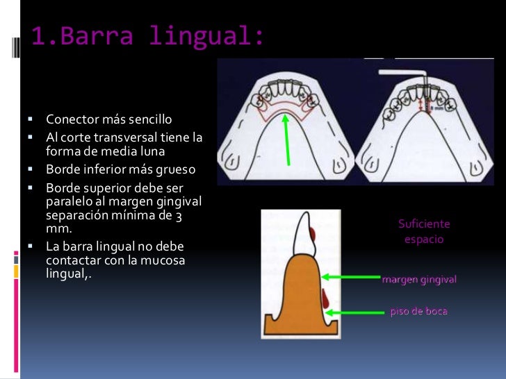 barra lingual superior protesis barra lingual superior protesis