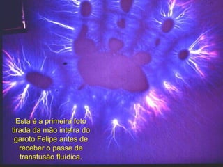 Esta é a primeira foto tirada da mão inteira do garoto Felipe antes de receber o passe de transfusão fluídica. 