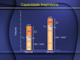 DPOC
CPT
CI
Volume
Normal
VR
CI
CPT
CRF / VPEF
VRE
VC
VRIVRI
CRF / VPEF
VR
VRE
VC
VRIVRI
Capacidade Inspiratória
 
