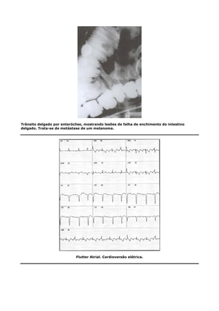 Trânsito delgado por enteróclise, mostrando lesões de falha de enchimento do intestino
delgado. Trata-se de metástase de um melanoma.
Flutter Atrial. Cardioversão elétrica.
 