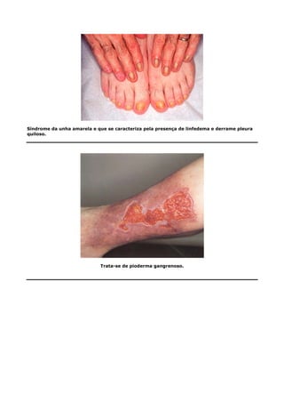 Síndrome da unha amarela e que se caracteriza pela presença de linfedema e derrame pleura
quiloso.
Trata-se de pioderma gangrenoso.
 