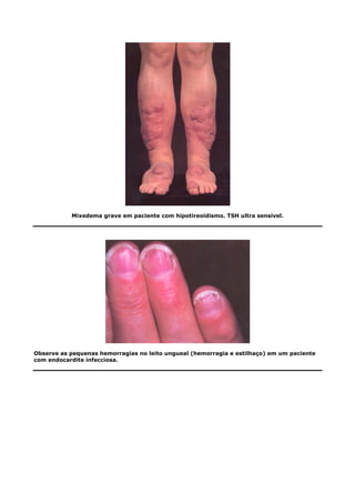Mixedema grave em paciente com hipotireoidismo. TSH ultra sensível.
Observe as pequenas hemorragias no leito ungueal (hemorragia e estilhaço) em um paciente
com endocardite infecciosa.
 