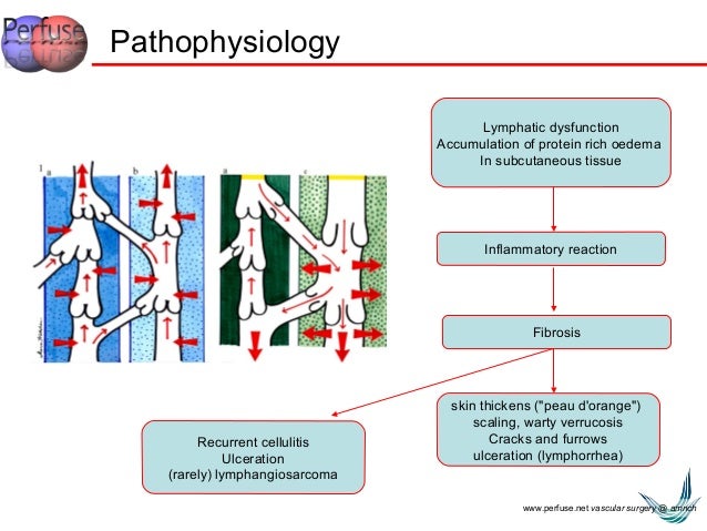 LYMPHEDEMA PATHOPHYSIOLOGY EBOOK DOWNLOAD LYMPHEDEMA PATHOPHYSIOLOGY EBOOK DOWNLOAD