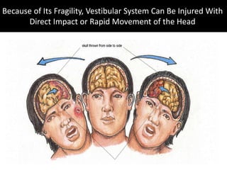 Because of Its Fragility, Vestibular System Can Be Injured With
Direct Impact or Rapid Movement of the Head
 