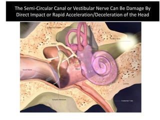 The Semi-Circular Canal or Vestibular Nerve Can Be Damage By
Direct Impact or Rapid Acceleration/Deceleration of the Head
 