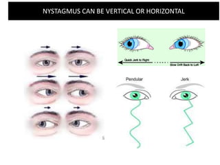NYSTAGMUS CAN BE VERTICAL OR HORIZONTAL
 