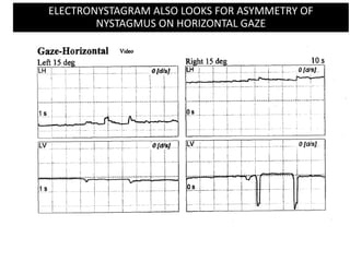 ELECTRONYSTAGRAM ALSO LOOKS FOR ASYMMETRY OF
NYSTAGMUS ON HORIZONTAL GAZE
 