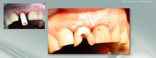 Customized provisional crown