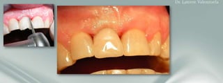 Customized provisional crown