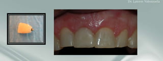 Customized provisional crown