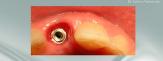 Customized provisional crown