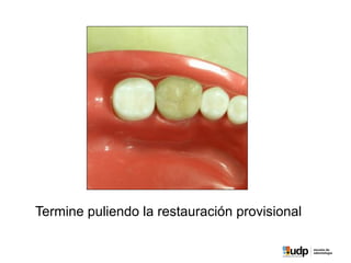 Termine puliendo la restauración provisional
 