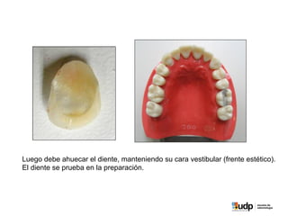 Luego debe ahuecar el diente, manteniendo su cara vestibular (frente estético).
El diente se prueba en la preparación.
 
