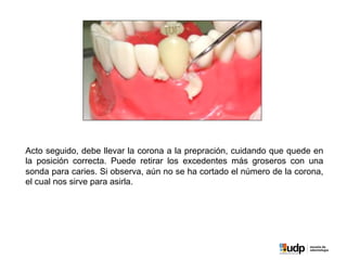Acto seguido, debe llevar la corona a la prepración, cuidando que quede en
la posición correcta. Puede retirar los excedentes más groseros con una
sonda para caries. Si observa, aún no se ha cortado el número de la corona,
el cual nos sirve para asirla.
 
