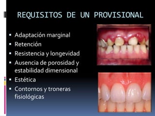 REQUISITOS DE UN PROVISIONAL
 Adaptación marginal
 Retención
 Resistencia y longevidad
 Ausencia de porosidad y
estabilidad dimensional
 Estética
 Contornos y troneras
fisiológicas
 