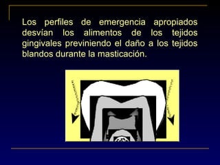 Los perfiles de emergencia apropiados
desvían los alimentos de los tejidos
gingivales previniendo el daño a los tejidos
blandos durante la masticación.
 