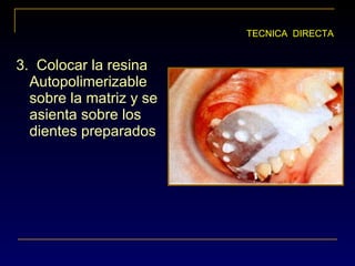 3. Colocar la resina
Autopolimerizable
sobre la matriz y se
asienta sobre los
dientes preparados
TECNICA DIRECTA
 