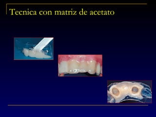Tecnica con matriz de acetato
 