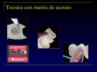Tecnica con matriz de acetato
 