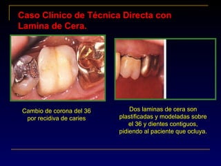 Caso Clínico de Técnica Directa conCaso Clínico de Técnica Directa con
Lamina de Cera.Lamina de Cera.
Cambio de corona del 36
por recidiva de caries
Dos laminas de cera son
plastificadas y modeladas sobre
el 36 y dientes contiguos,
pidiendo al paciente que ocluya.
 