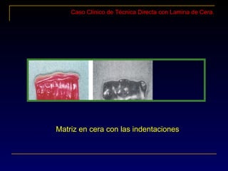 Caso Clínico de Técnica Directa con Lamina de Cera.
Matriz en cera con las indentaciones
 