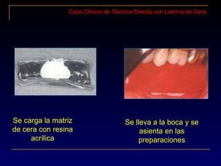 Caso Clínico de Técnica Directa con Lamina de Cera.
Se carga la matriz
de cera con resina
acrílica
Se lleva a la boca y se
asienta en las
preparaciones
 