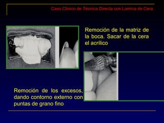 Caso Clínico de Técnica Directa con Lamina de Cera.
Remoción de la matriz de
la boca. Sacar de la cera
el acrílico
Remoción de los excesos,
dando contorno externo con
puntas de grano fino
 