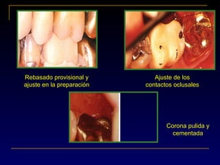 Ajuste de los
contactos oclusales
Corona pulida y
cementada
Rebasado provisional y
ajuste en la preparación
 