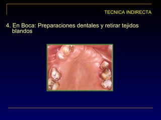 TECNICA INDIRECTA
4. En Boca: Preparaciones dentales y retirar tejidos
blandos
 