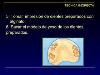 TECNICA INDIRECTA
5. Tomar impresión de dientes preparados con
alginato.
6. Sacar el modelo de yeso de los dientes
preparados.
 