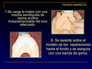 TECNICA INDIRECTA
7.Se carga la matriz con una
mezcla semilíquida de
resina acrílica
Autopolimerizable del tono
adecuado.
8. Se asiente sobre el
modelo de las reparaciones
hasta el fondo y se asegura
con una banda de goma.
 