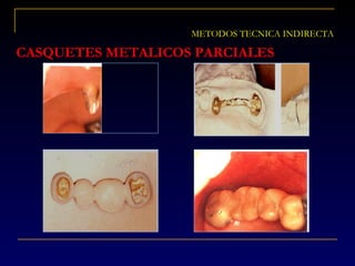 CASQUETES METALICOS PARCIALES
METODOS TECNICA INDIRECTA
 