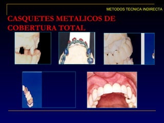 CASQUETES METALICOS DE
COBERTURA TOTAL
METODOS TECNICA INDIRECTA
 