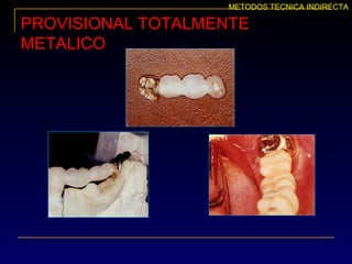 PROVISIONAL TOTALMENTE
METALICO
METODOS TECNICA INDIRECTA
 