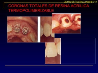 CORONAS TOTALES DE RESINA ACRILICA
TERMOPOLIMERIZABLE
METODOS TECNICA INDIRECTA
 