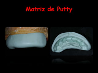 Matriz de Putty
 