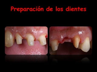 Preparación de los dientes
 