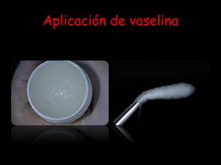 Aplicación de vaselina
 