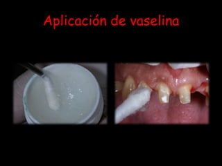 Aplicación de vaselina
 