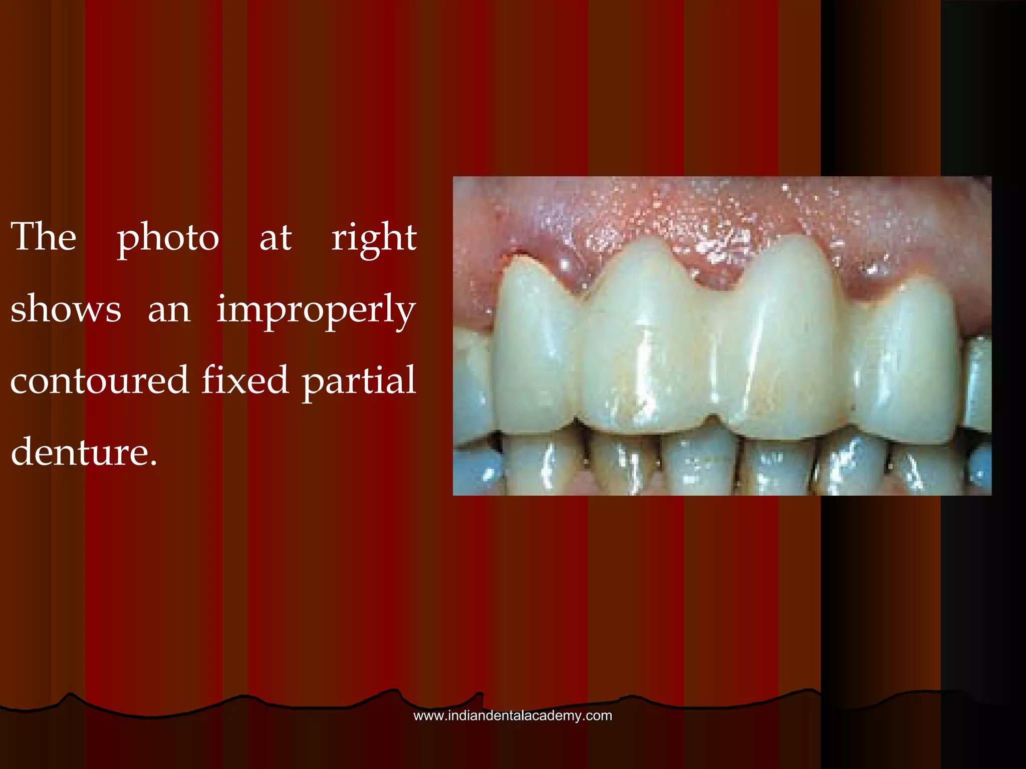 5. Proper contours: A provisional must have proper
contours for esthetics and for gingival health. In a fixed
partial denture, the pontic must be contoured so that it is
as self cleansing as possible.
www.indiandentalacademy.comwww.indiandentalacademy.com
 
