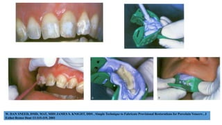 W. DAN SNEED, DMD, MAT, MHS JAMES S. KNIGHT, DDS , Simple Technique to Fabricate Provisional Restorations for Porcelain Veneers , J
Esthet Restor Dent 13:115-119, 2001
 